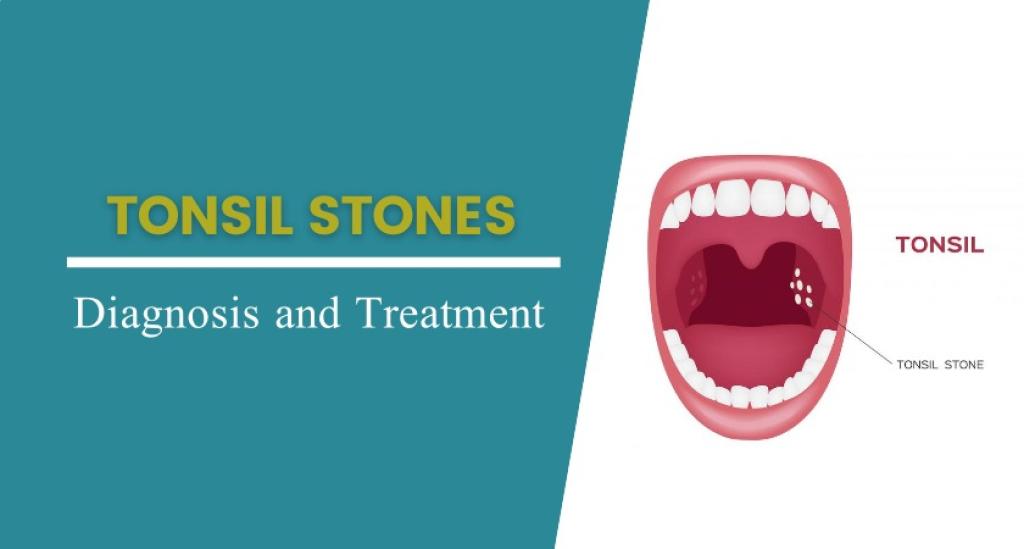 How to Prevent Tonsil Stones for Good: Simple and Effective Solutions