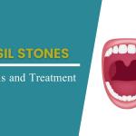 How to Prevent Tonsil Stones for Good: Simple and Effective Solutions