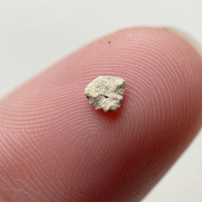 Kidney Stone Size Chart Explained: From Tiny Crystals to Large Stones