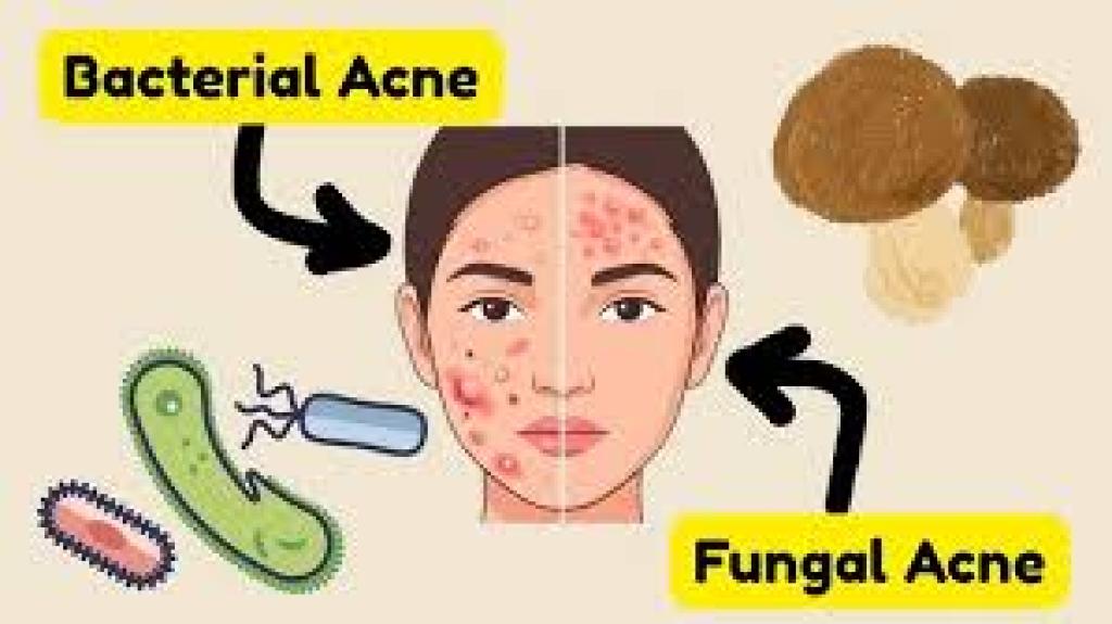 Fungal vs Bacterial Acne: Key Differences, Symptoms, and Treatment Guide (2026 Complete Guide)