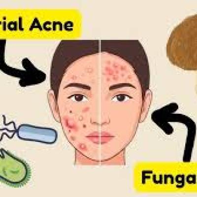 Fungal vs Bacterial Acne: Key Differences, Symptoms, and Treatment Guide (2026 Complete Guide)