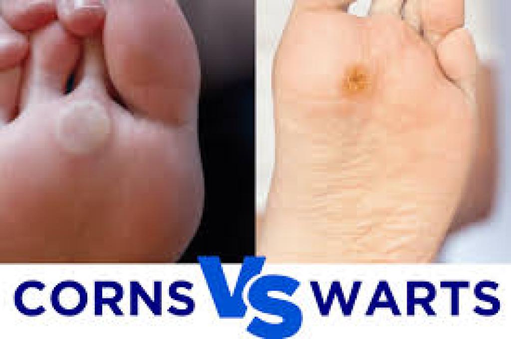 Corn vs Wart Explained: Causes, Treatment, and Easy Identification Tips