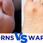 Corn vs Wart Explained: Causes, Treatment, and Easy Identification Tips