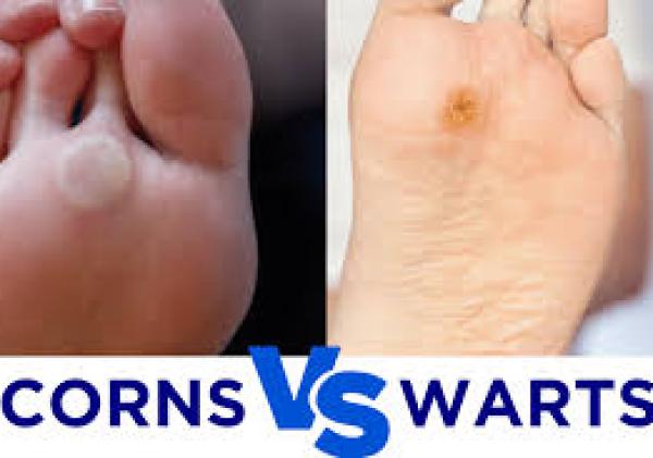 Corn vs Wart Explained: Causes, Treatment, and Easy Identification Tips