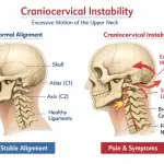 Craniocervical Instability: 7 Critical Symptoms, Causes, and Best Treatments (2026 Guide)