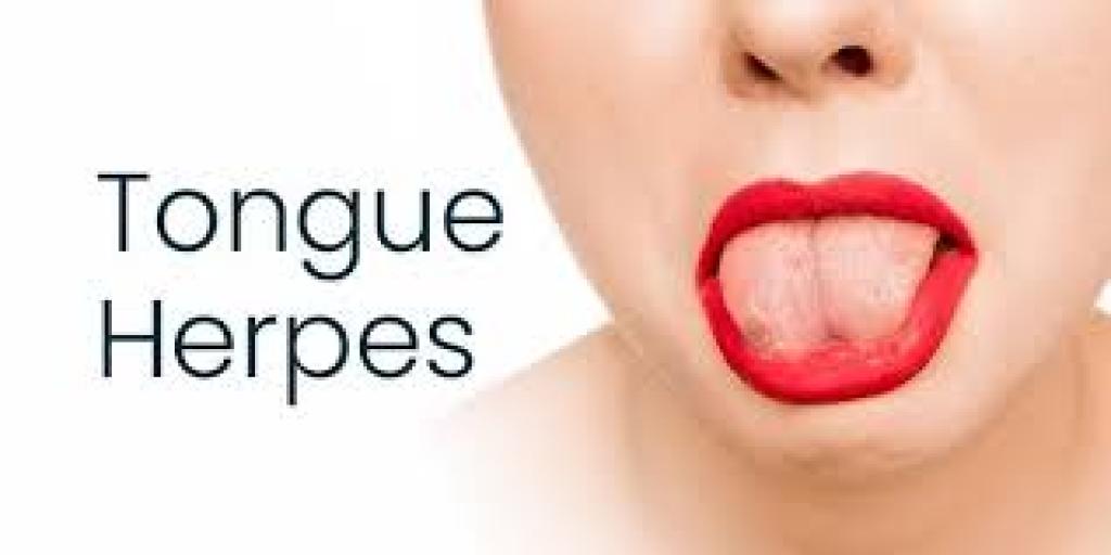 Herpes on Tongue: Symptoms, Causes, Pictures, and Treatment Options