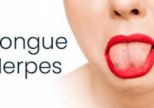 Herpes on Tongue: Symptoms, Causes, Pictures, and Treatment Options