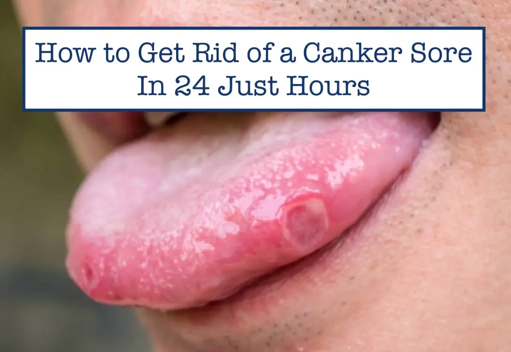 How to Get Rid of a Canker Sore in 24 Hours: Expert Tips for Quick Relief