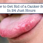 How to Get Rid of a Canker Sore in 24 Hours: Expert Tips for Quick Relief