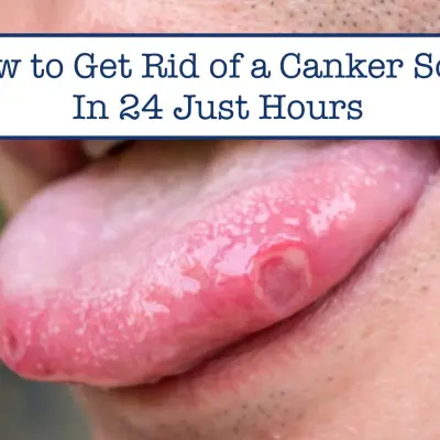 How to Get Rid of a Canker Sore in 24 Hours: Expert Tips for Quick Relief