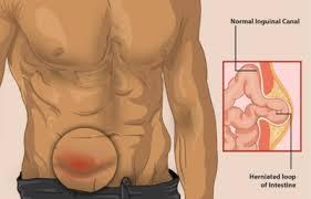 Hernia - Physiopedia