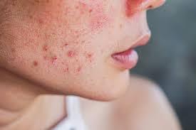 Dry Skin But Breaking Out? Here's What ...