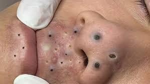 Big Cystic Acne Blackheads Extraction ...