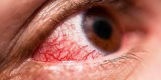 Sore Eyes: Conjunctivitis symptoms ...