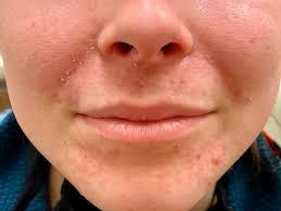 Pesky pink bumps around the mouth: it ...