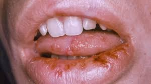 Tongue Herpes: How to Identify, Treat ...
