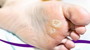 Do You Have A Foot Corn Or Wart? Find ...