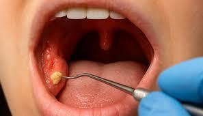 Tonsil Stones Naturally Without Surgery