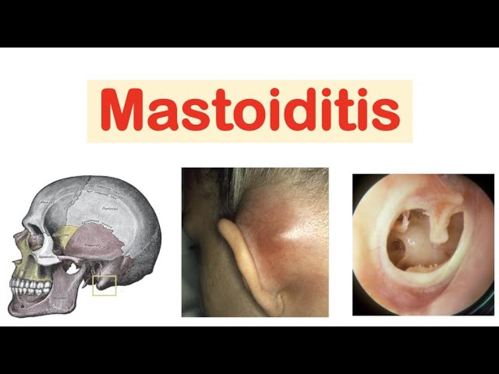 Mastoid Effusion Explained: Causes, Symptoms, and Treatment Options