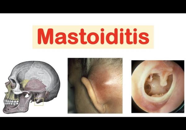 Mastoid Effusion Explained: Causes, Symptoms, and Treatment Options