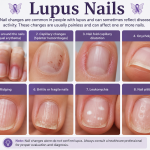 Lupus Nails: 10 Warning Signs, Changes, and What They Mean for Your Health (2026 Guide)