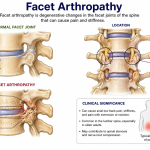 Facet Arthropathy Explained: Symptoms, Causes, and Best Treatment Options
