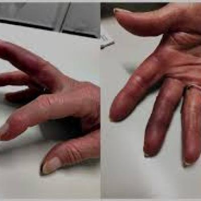 Smashed Finger Swelling and Purple: Signs of Injury, Healing Stages, and Care