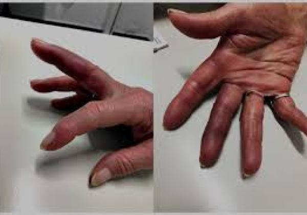 Smashed Finger Swelling and Purple: Signs of Injury, Healing Stages, and Care