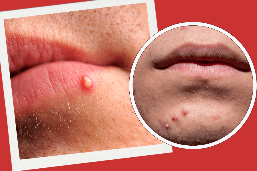 White-pimples-on-lip-causes-treatment-and-prevention-guide-Acne-Express